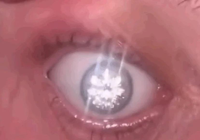 Американец вживил в свой искусственный глаз бриллиант весом в два карата