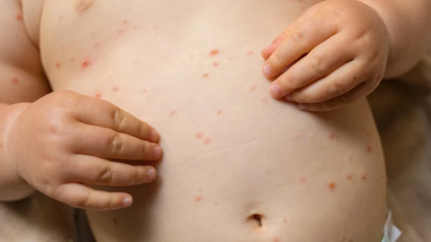Заболеваемость ветряной оспой растёт в Алматы: число осложнённых случаев увеличилось на 40%