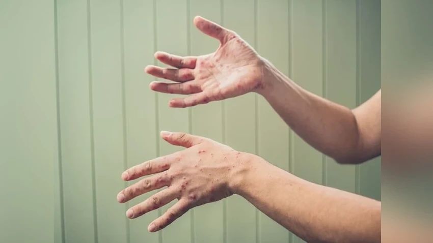 В Монголии зафиксировано еще 2 случая смерти от кори